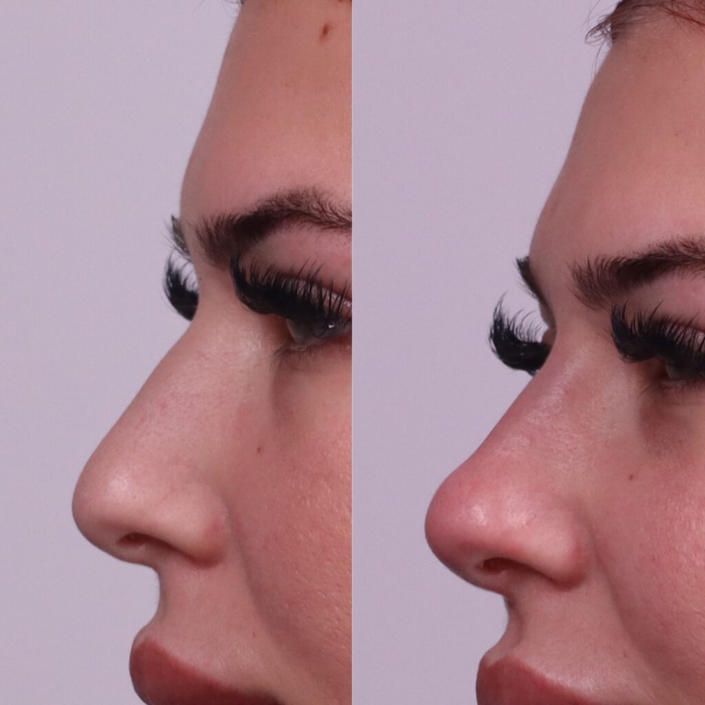 non-surgical-nose-filler-brisbane-cosmetic-doctor-brisbane