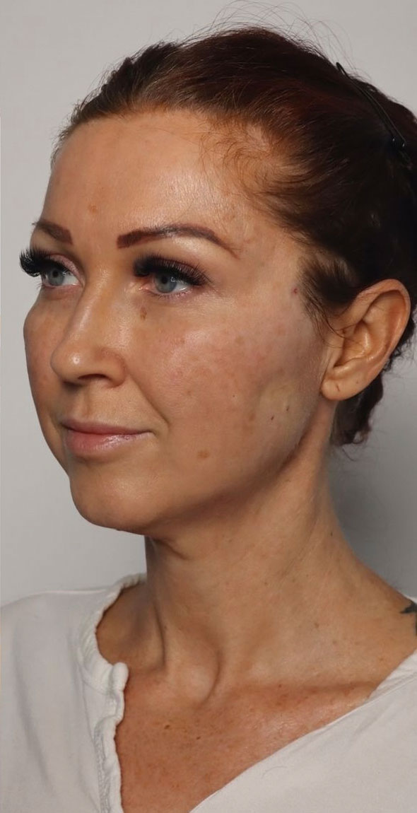 A woman with fair skin, blue eyes, and dark hair pulled back, looking slightly to the side. She is wearing a white top and has subtle makeup that highlights her sculpted features. Her accentuated eyebrows complement the refined look achieved by a thread lift. The background is plain and neutral.